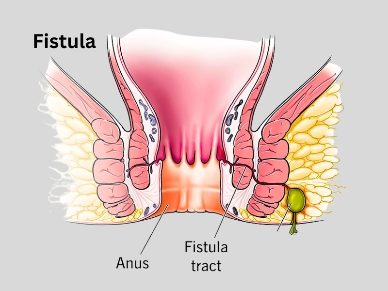 Procto Dehradun - Best Proctologist in Dehradun, Piles Doctor in dehradun
