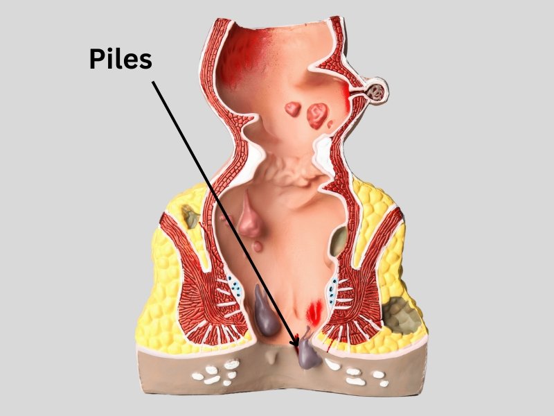 Procto Dehradun - Best Proctologist in Dehradun, Piles Doctor in dehradun