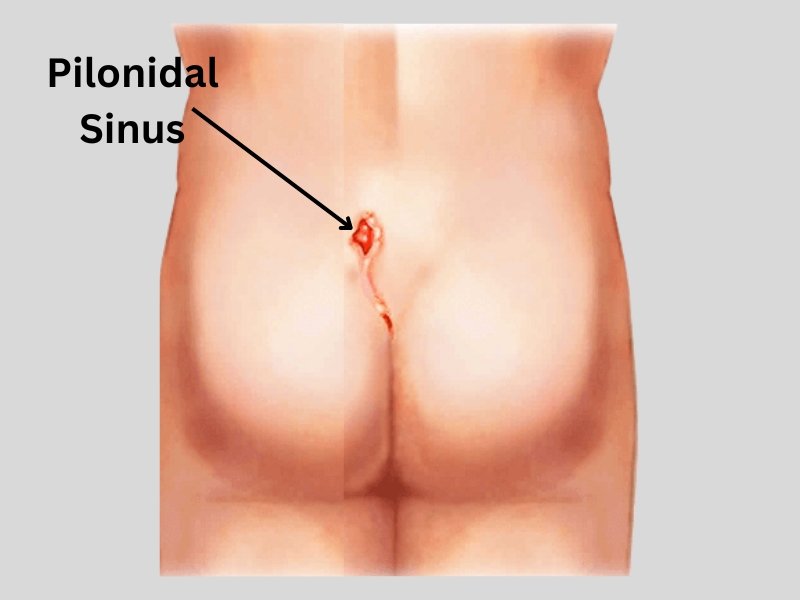 Procto Dehradun - Best Proctologist in Dehradun, Piles Doctor in dehradun